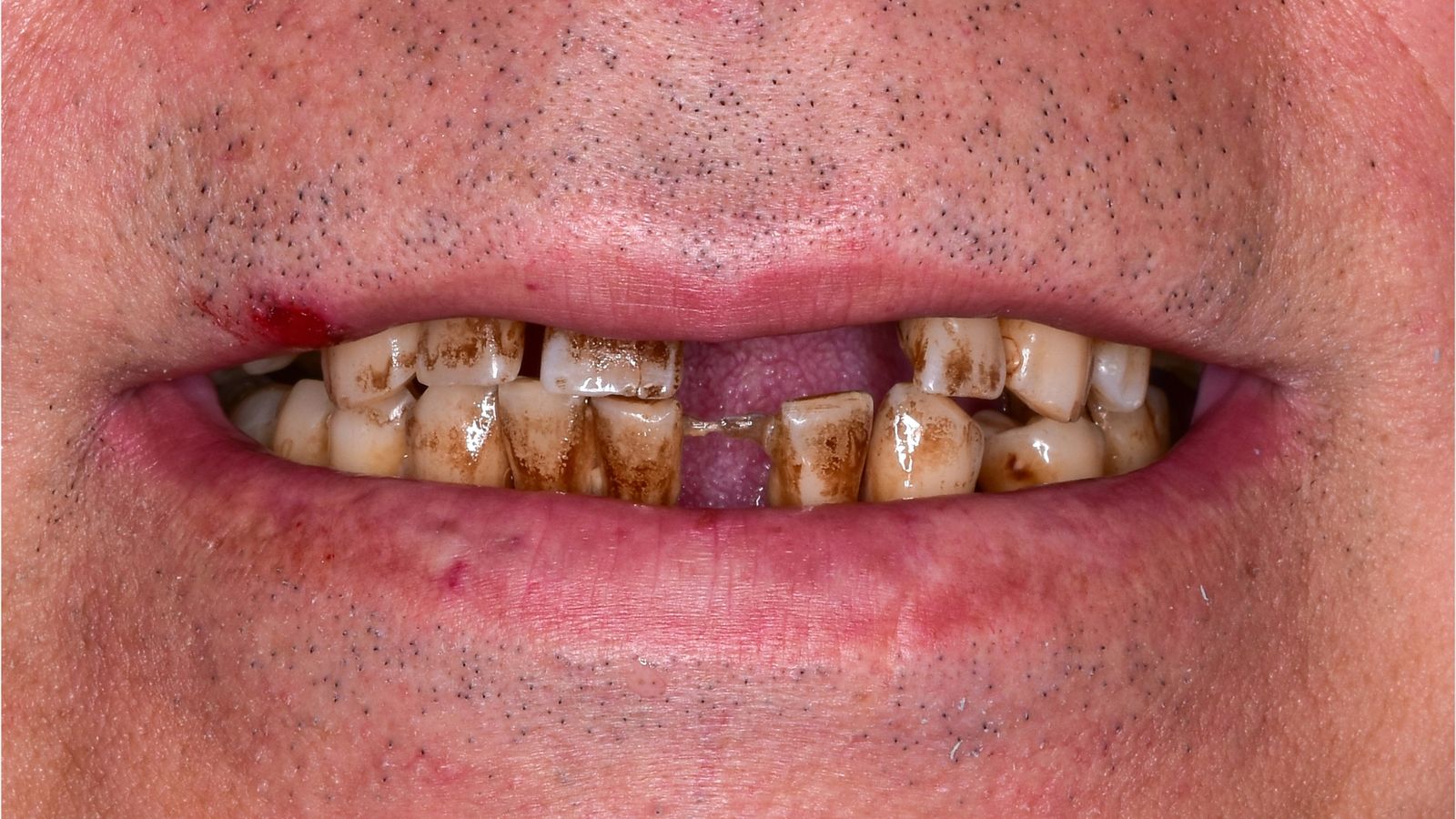 Zahnlücke im Seitenzahnbereich vor der Behandlung